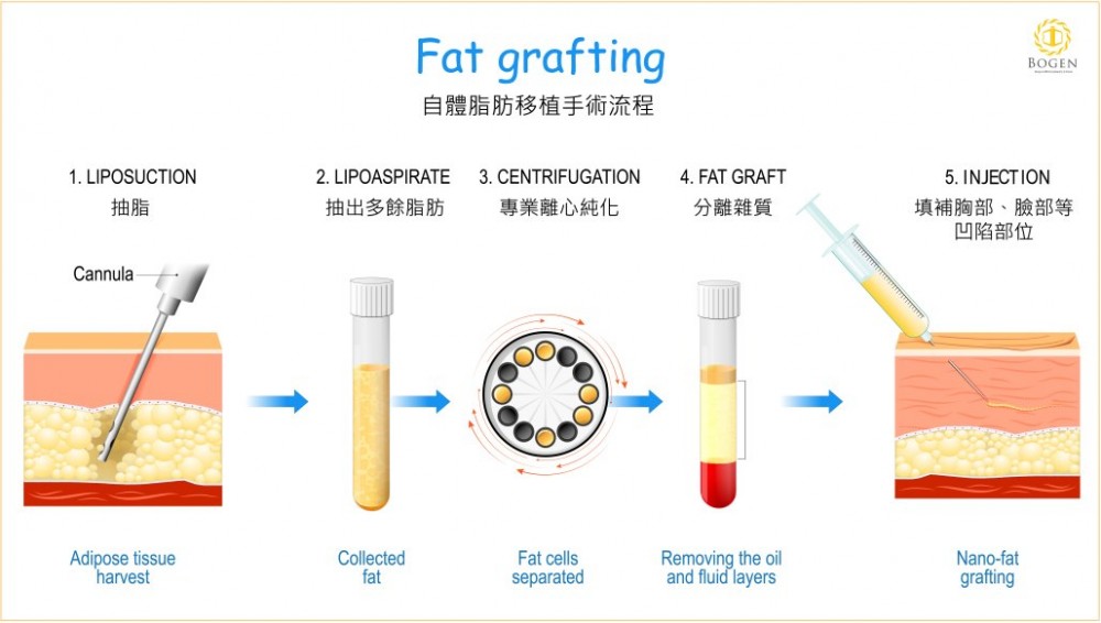 自體脂肪移植手術流程,自體脂肪移植原理,博恩妍